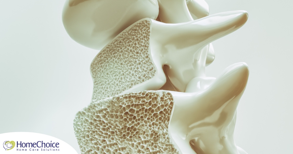 An image of a spine with the inside exposed represents osteoporosis.